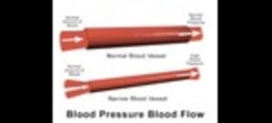 High Blood Pressure Symptoms