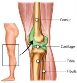 Bone Cancer in the Knee