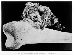 osteosarcoma?