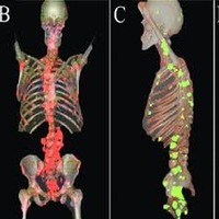 Elective medicines for most prostate cancer bone metastases